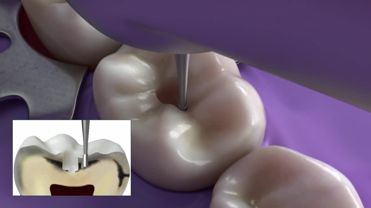 牙齿三维机理CG动画